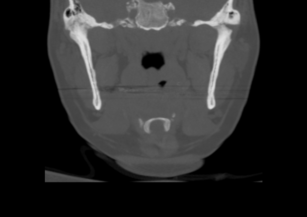 TMJ-Migraine-Symptoms